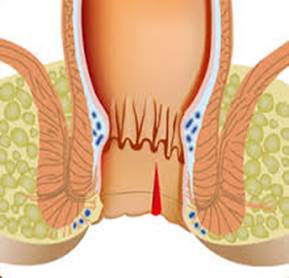 How long do anal fissures last